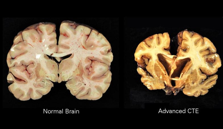 The Harmful Neurological Effects of Football on the Human Brain