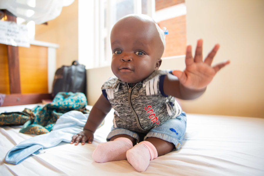 A hydrocephalus patient at the CURE Children's Hospital of Uganda Photo Credit: https://cure.org/2021/01/conditions-we-treat-hydrocephalus/