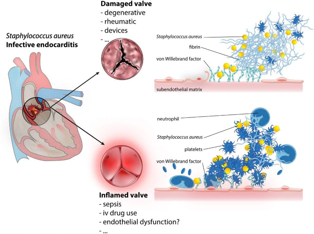 Differential mechanisms of S. aureus adhesion to damaged or inflamed heart valves.